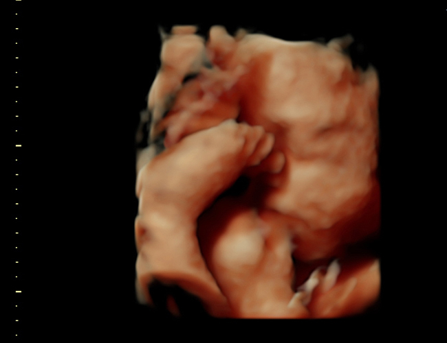 3D ultrasound image at 31 weeks